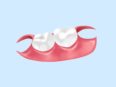 ノンクラスプデンチャー……部分入れ歯（保険適用外）