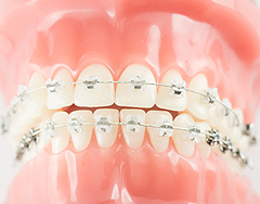 歯並びが気になる 矯正治療