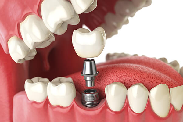 Implant 失った歯の機能を取り戻す治療～インプラント治療～