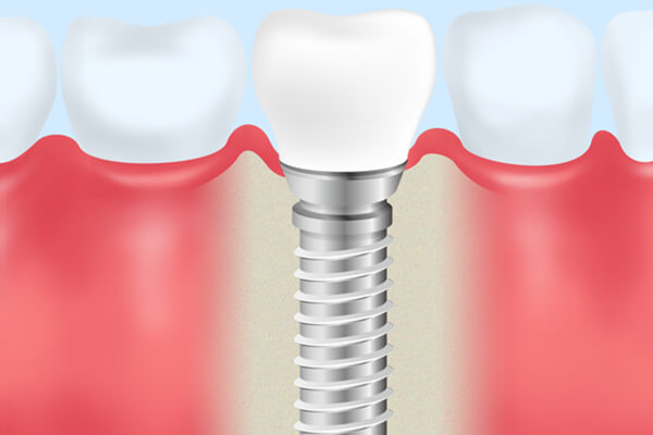 インプラント